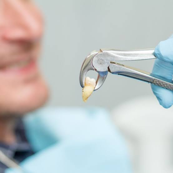 Tooth Extraction