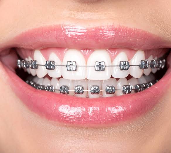 Orthodontic Braces