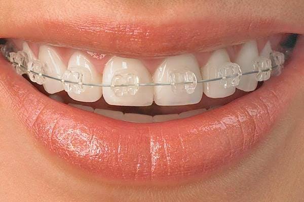 Ceramic Clear Braces