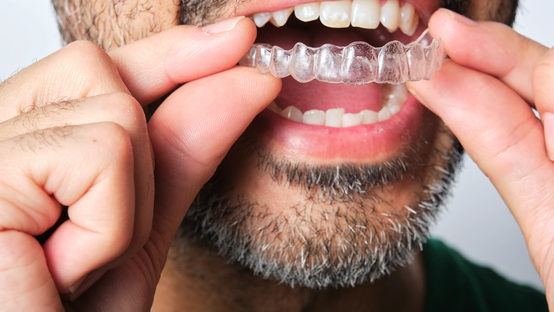 Clear Aligners Invisible Braces