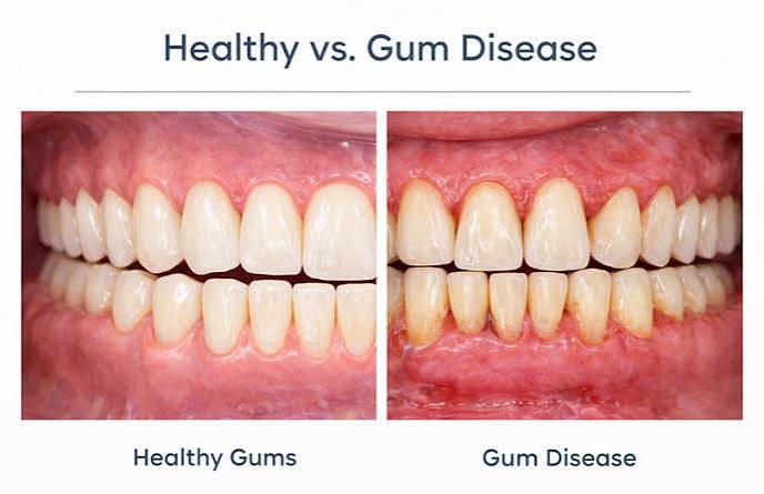 Healthy vs Unhealthy Gums